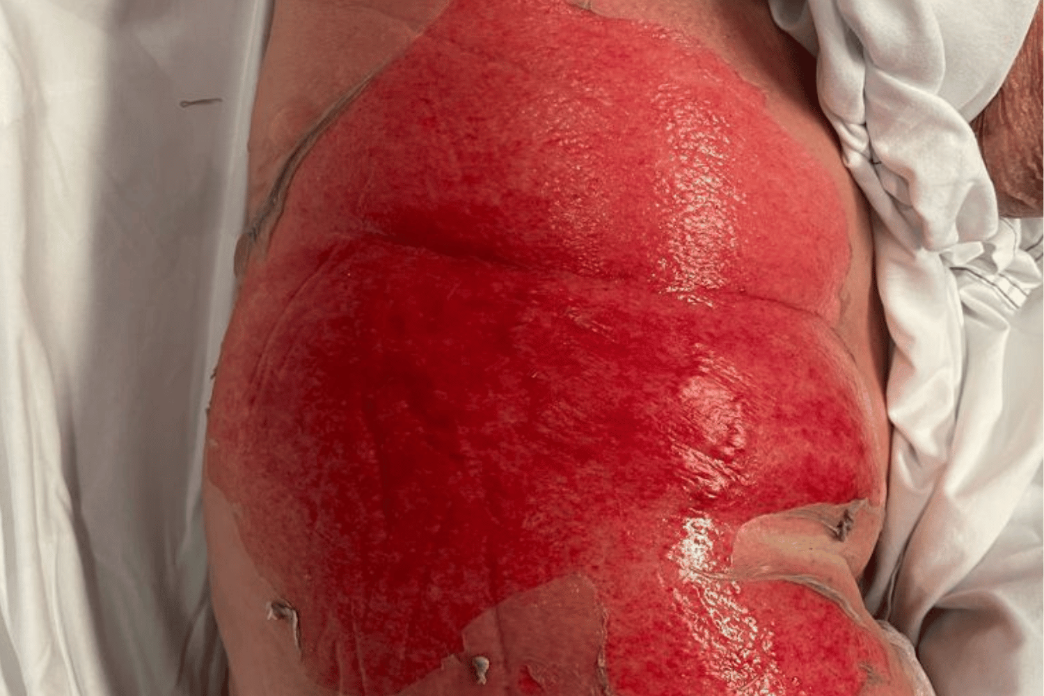 https://www.vicburns.org.au/files/general/1500x1000/Deep_dermal_burn_leg_web.png