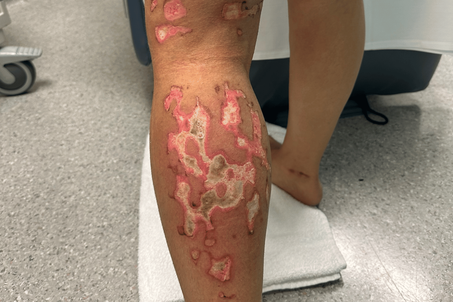 https://www.vicburns.org.au/files/general/1500x1000/Full_thickness_burn_back_of_leg_web.png