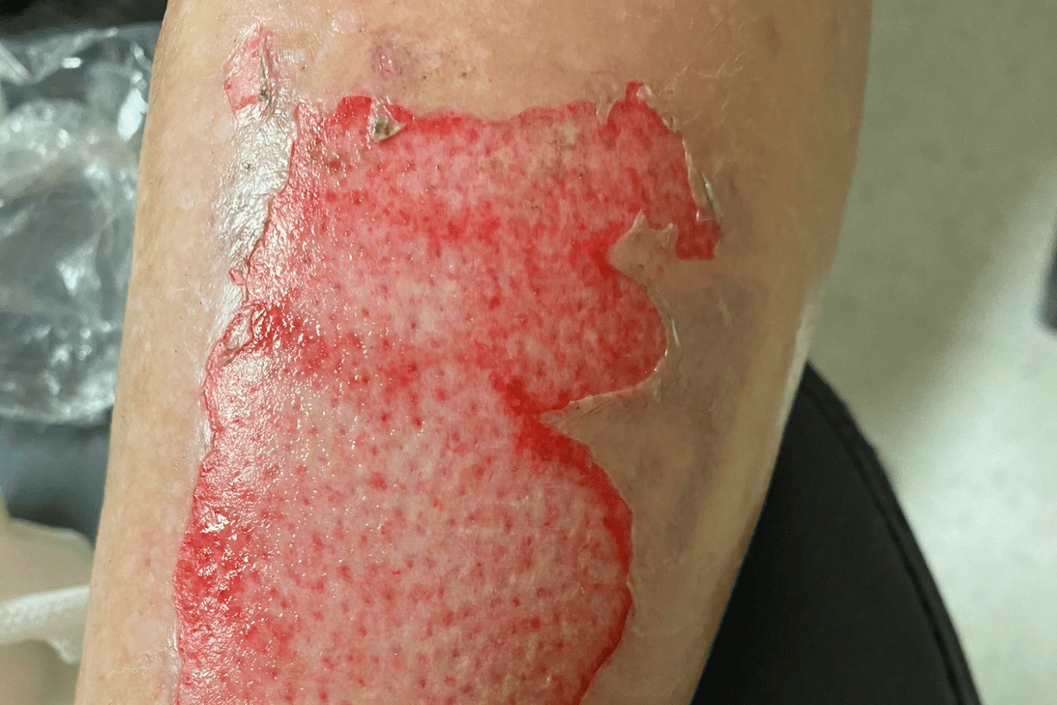 https://www.vicburns.org.au/files/general/1500x1000/Mid_dermal_burn_calf_web_web.png