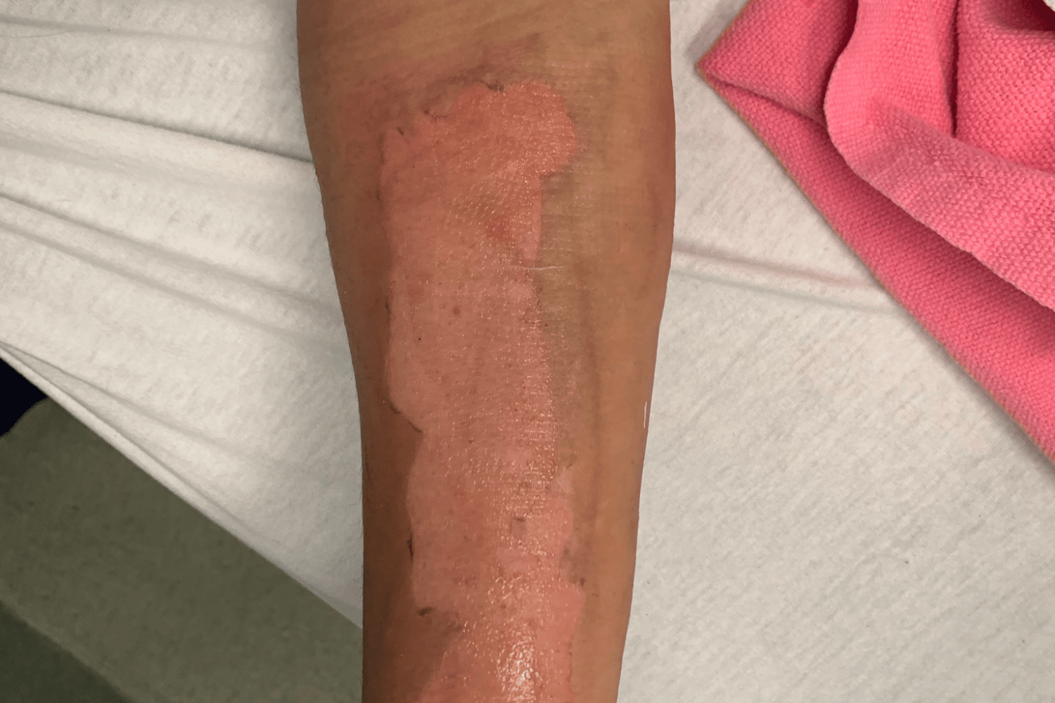 Minor burn wound managment | VicBurns