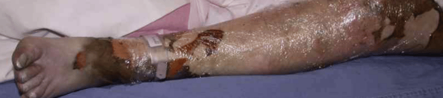 https://www.vicburns.org.au/files/general/900x200/Circumferential_leg_burn.png