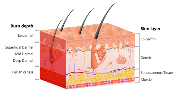 https://www.vicburns.org.au/files/general/Burn_depth_diagram.PNG