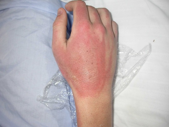 https://www.vicburns.org.au/files/general/epidermal_burn.jpg