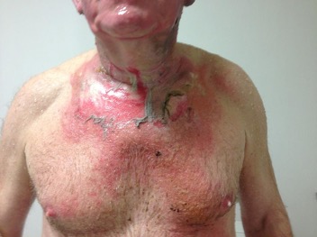 https://www.vicburns.org.au/files/general/epidermal_superficial_burn.jpg